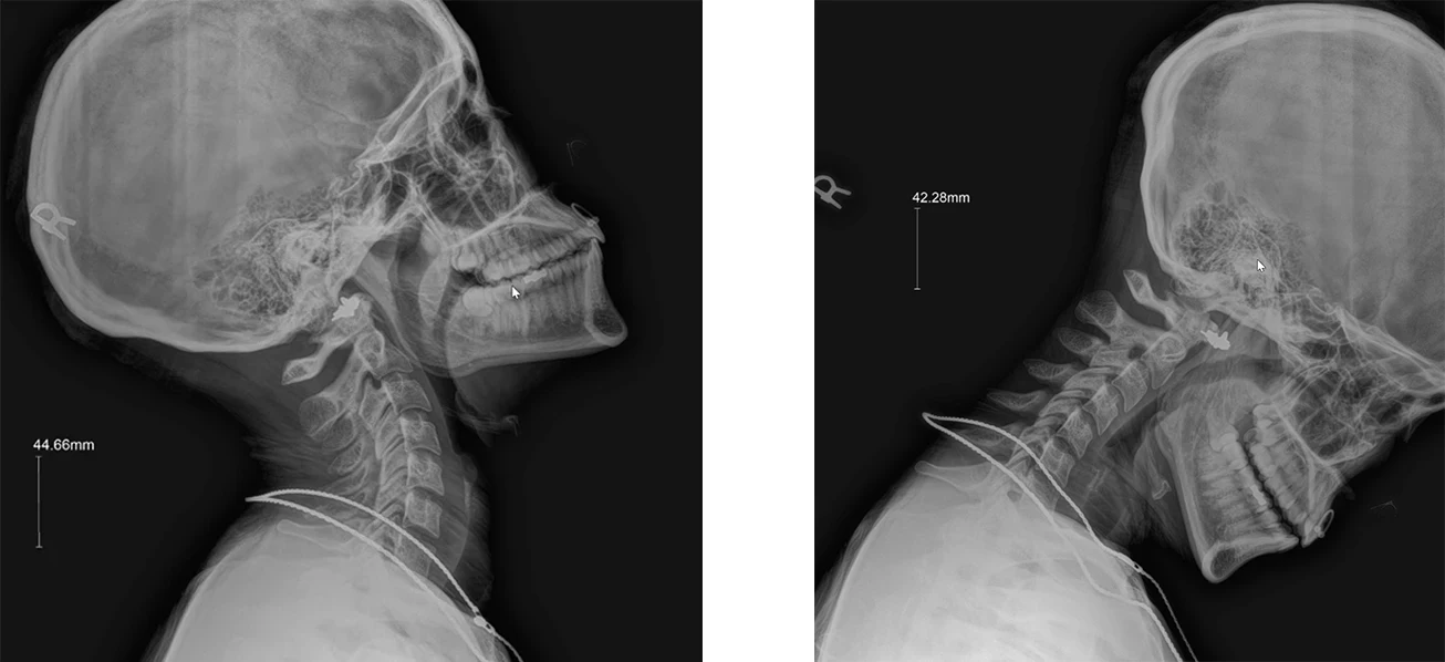 Chiropractic Downers Grove IL Cervical Ext Flex